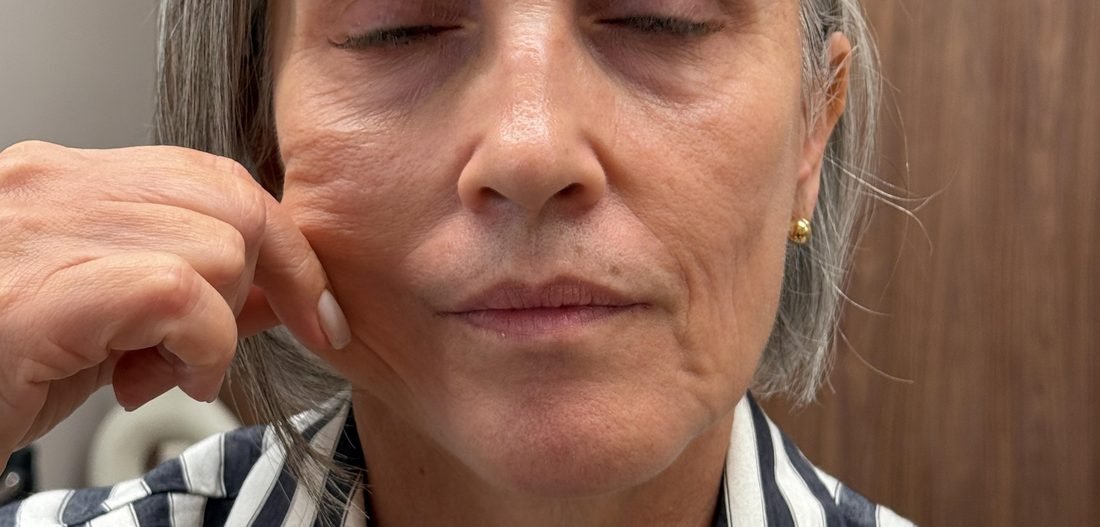 Antes — flacidez facial