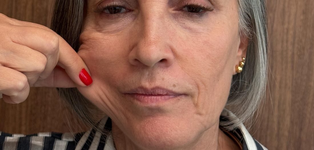 Depois — Liftera 2 e bioestimulador