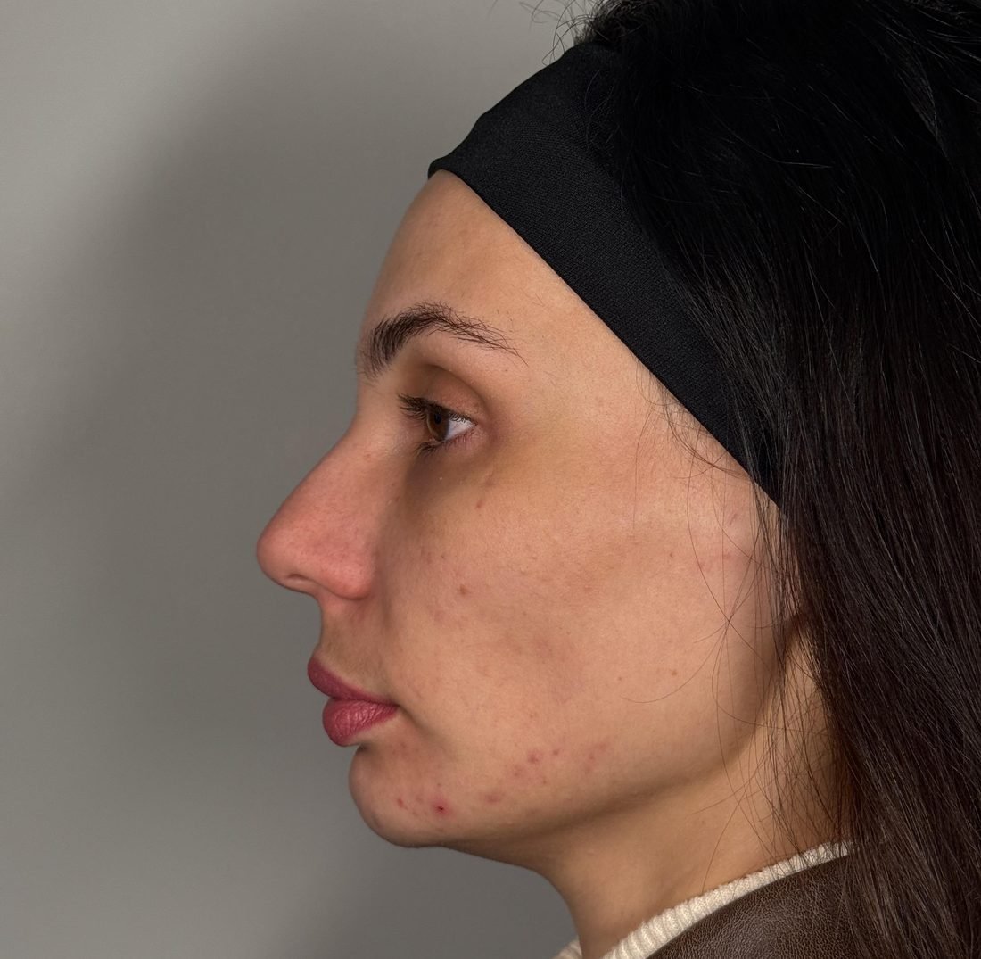 Antes — perfil com acne e mento retraído