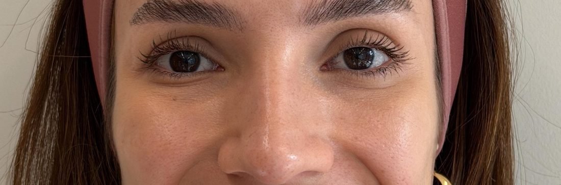 Antes — região dos olhos em repouso
